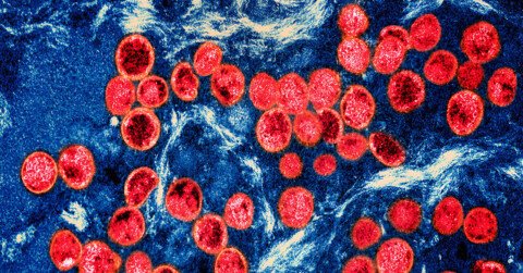 Severe Strain of Monkeypox Virus Detected in Los Angeles