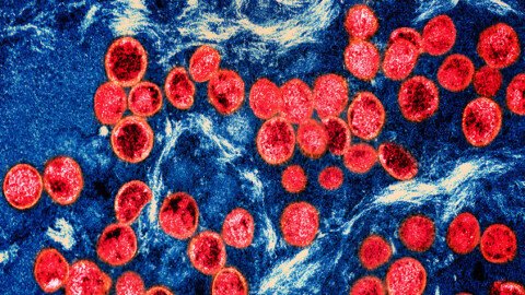 Severe Strain of Monkeypox Virus Detected in Los Angeles