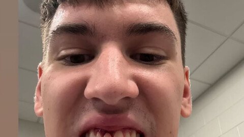 Lakers’ Jake LaRavia shows off gnarly wound suffered during Sixers game