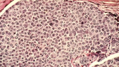 This startup wants to destroy cancer tumors using ultrasound instead of surgery