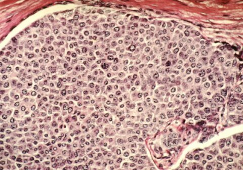 This startup wants to destroy cancer tumors using ultrasound instead of surgery