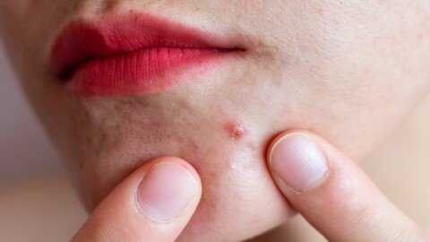 How eczema and acne can affect your mental health